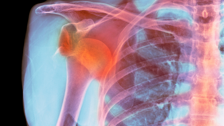 Strong Evidence Favors Surgery After One Shoulder Dislocation