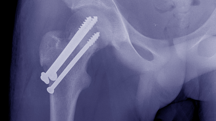Surprise: Pinning Fails in 15% of Valgus-impacted Hip Fractures