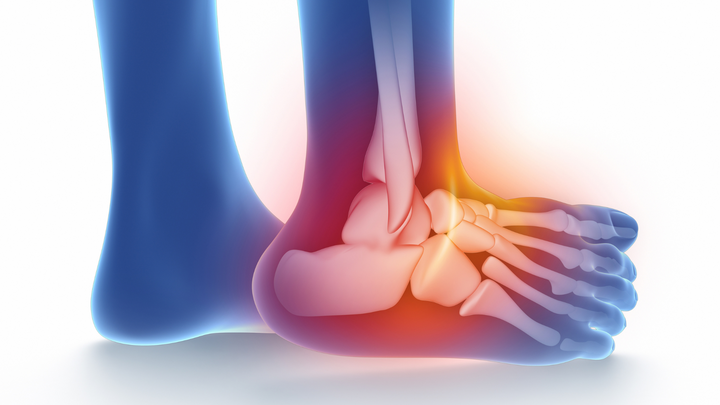 Treating Lateral Ankle Instability To Address Chondral Lesions