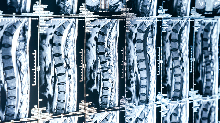 Other Tests Are “Better,” So Why Stick With MRI for Vertebral Osteomyelitis?