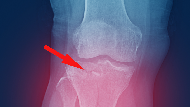 When It’s OK To Do Acute ORIF for High-energy Tibial Plateau Fractures