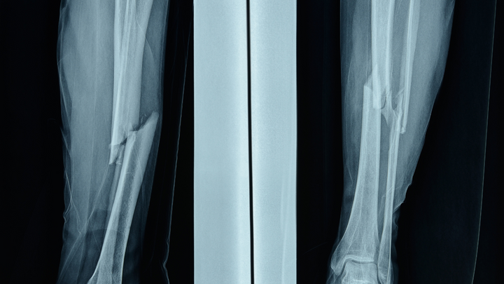 Residual Disability After Distal Tibial Fractures