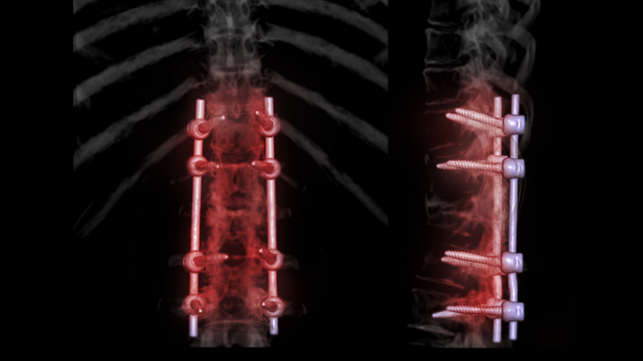 RCT Finds Problems With Uninstrumented Fusions for Stenosis + Spondylolisthesis