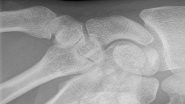 One More for Your Scaphoid Nonunion Bag of Tricks
