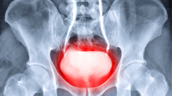 Preventing Urinary Retention After Lumbar Surgery