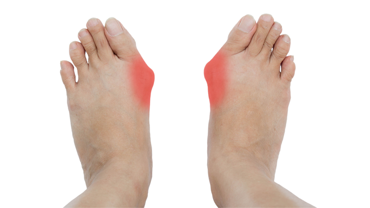 Is the SERI Osteotomy for Hallux Valgus Reliable?