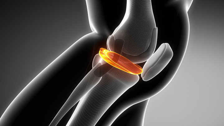 Think Twice Before Fixing Lateral Meniscal Tears at Time of ACL Reconstruction