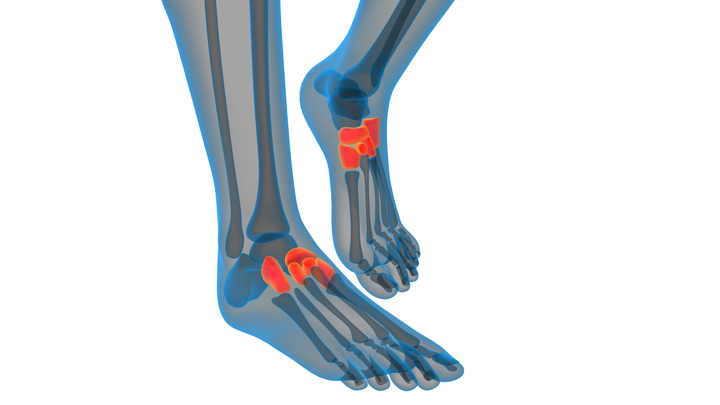 Hard Pass on Deep Peroneal Neurectomy for Midfoot Arthritis