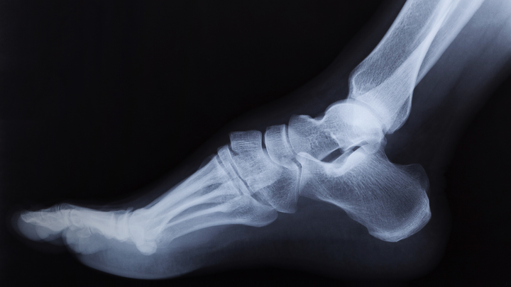 Conversion From Ankle Fusion to Arthroplasty — Good, Not Great