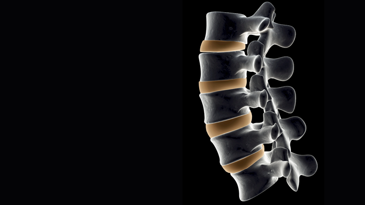 No Advantage to Cervical Disc Replacement Over One-level ACDF