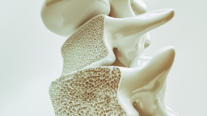 Healthcare Disparities Affect Men for Osteoporosis, and Here’s What You Can Do