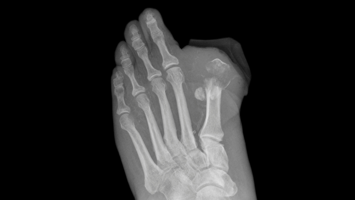 Associating Residual First Ray Length With Problems After Isolated First Metatarsal Amputations in Patients With Diabetes