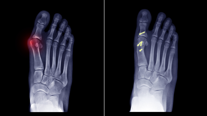 Modern Approaches to Hallux IP Fusions — Better or Not?
