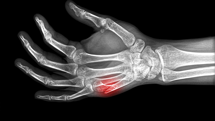 Nice RCT Changes the Game on Metacarpal Shaft Fractures