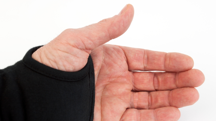Bracing Carpometacarpal Arthritis of the Thumb — Really