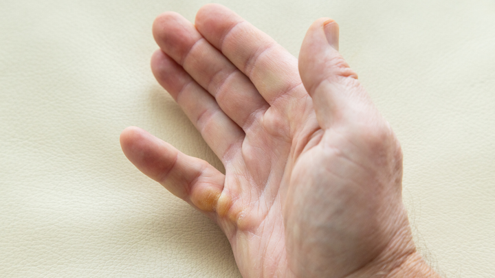 No Difference = Clear Choice for Patients With Single-digit Dupuytren Contractures