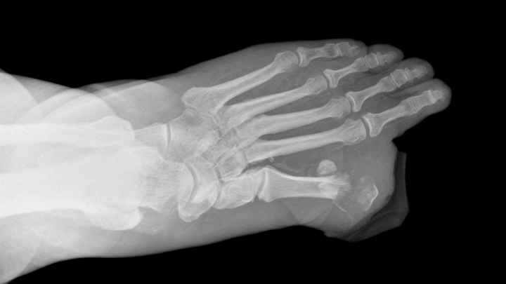 “Amputation-free” Resection or Amputation for Diabetic Foot Osteomyelitis — Tough Calls