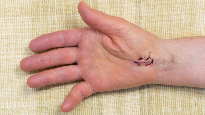 Suture Choice After Carpal Tunnel Release — Religion or Science?